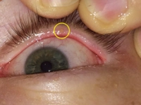 Göz Kapağında Yağ Bezesi Göz Kapağında Yağ Bezesi